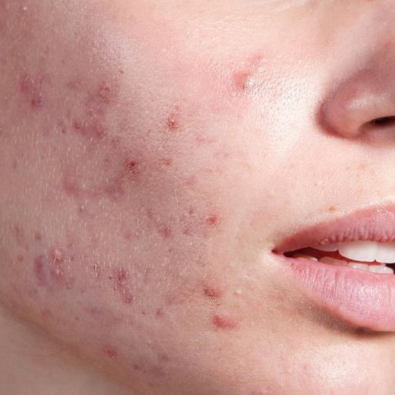 Acne care
